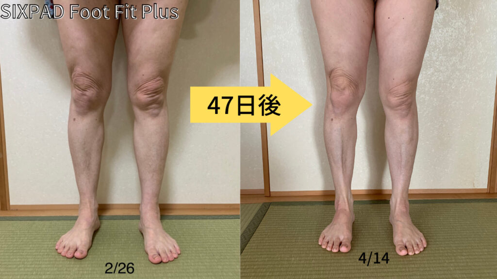 Foot Fit Plus(フットフィットプラス)を6ヶ月使用した結果｜ビフォー